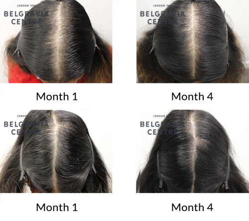 female pattern hair loss the belgravia centre 430428 1