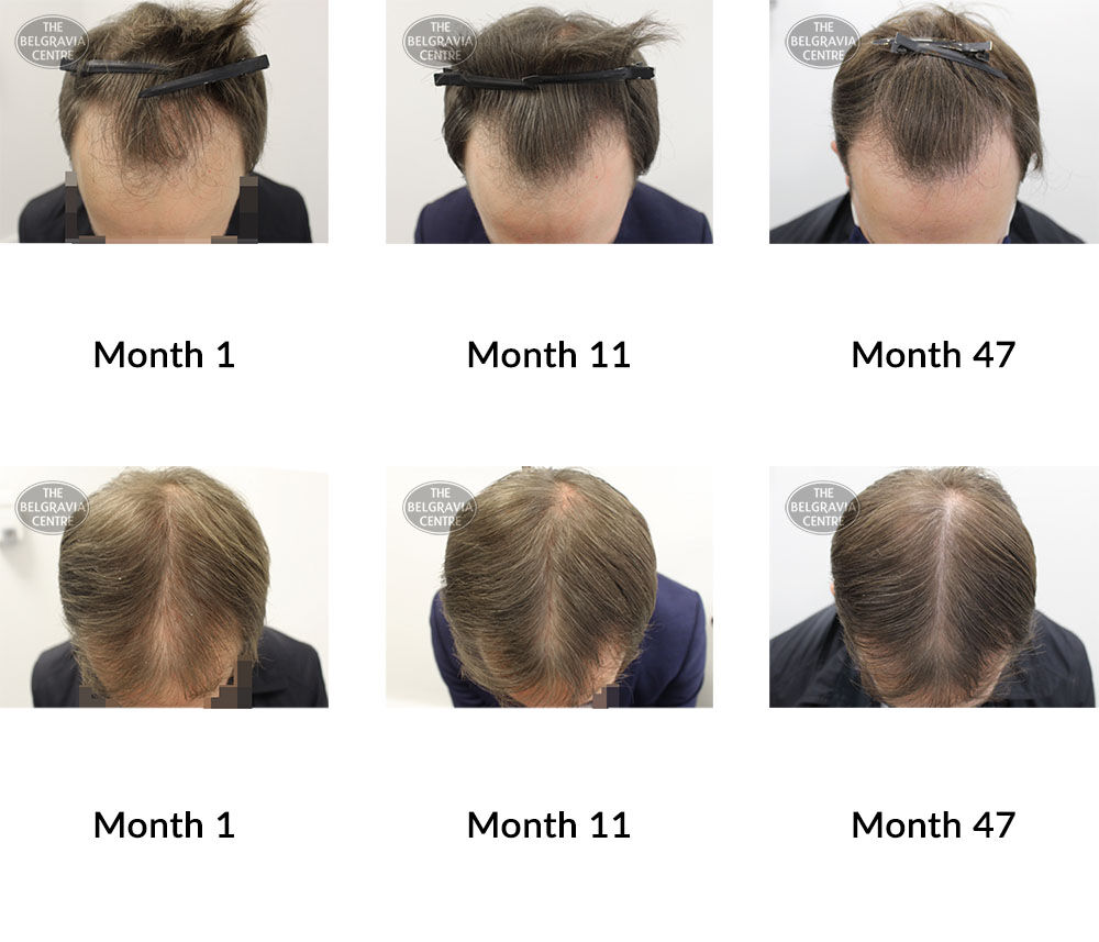 male pattern hair loss the belgravia centre 348966 14 10 2021