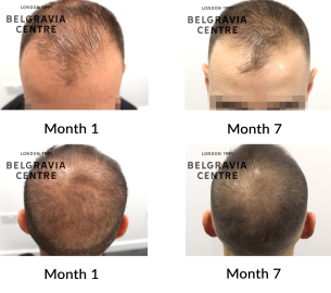 male pattern hair loss the belgravia centre 458485