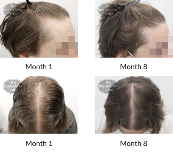 male pattern hair loss the belgravia centre 389280 02 10 2020