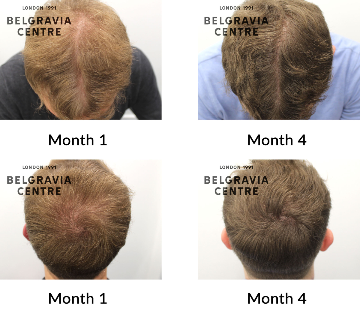 male pattern hair loss the belgravia centre 448030