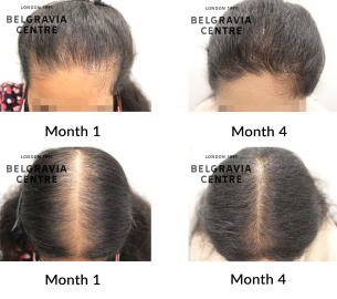 female pattern hair loss and diffuse hair loss the belgravia centre 459817