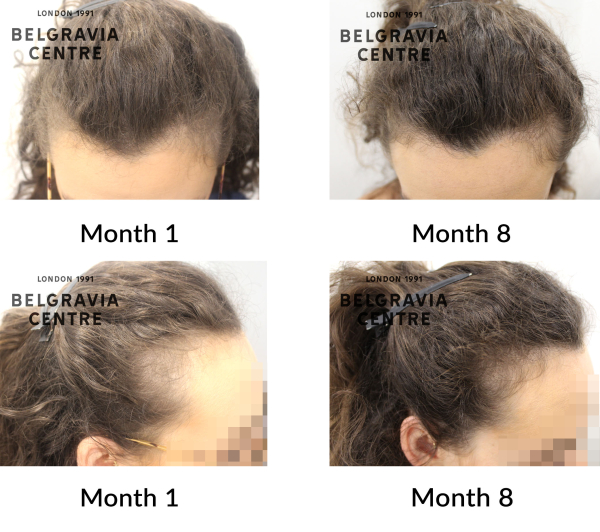 female pattern hair loss and telogen effluvium the belgravia centre 449157