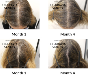 female pattern hair loss the belgravia centre 447684