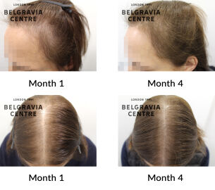 female pattern hair loss the belgravia centre 446583