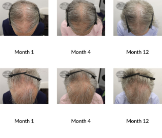 male pattern hair loss the belgravia centre 387998 19 08 2020