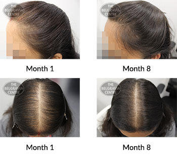 alert female pattern hair loss the belgravia centre 382761 07 06 2021