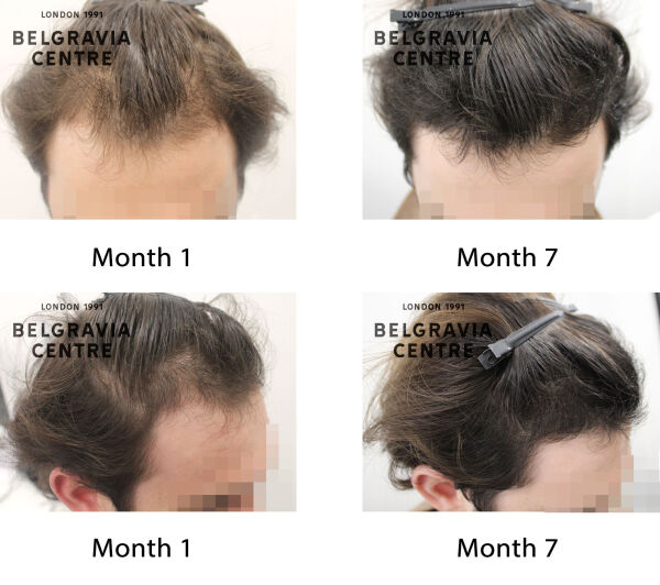 male pattern hair loss the belgravia centre 439333