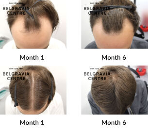 male pattern hair loss the belgravia centre 433637
