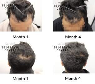 male pattern hair loss the belgravia centre 441557