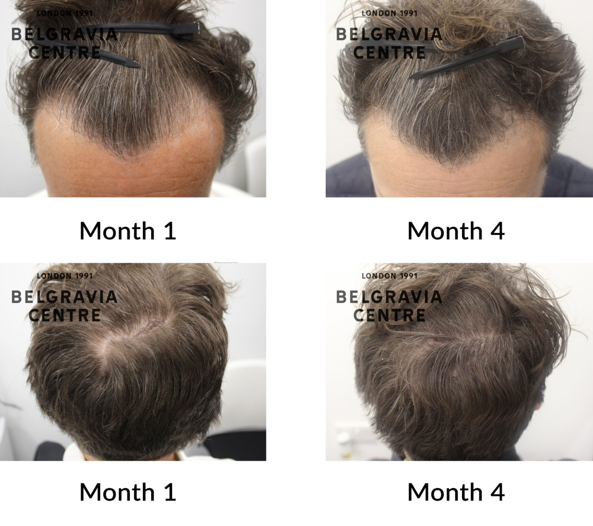 male pattern hair loss the belgravia centre 444136
