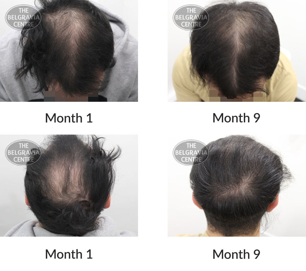 male pattern hair loss the belgravia centre 395091 28 09 2020