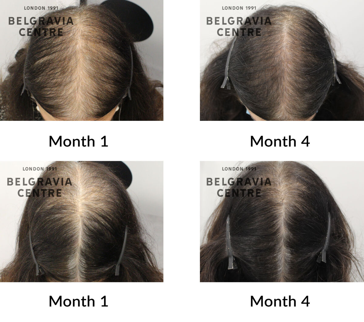 female pattern hair loss the belgravia centre 429641