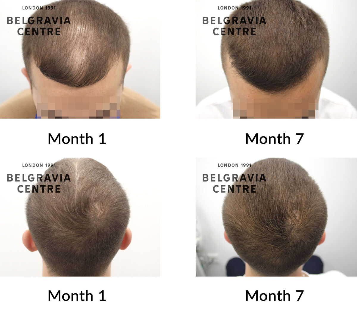 male pattern hair loss the belgravia centre 431381