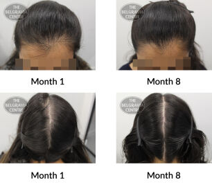female pattern hair loss and diffuse thinning the belgravia centre 408806 02 08 2021