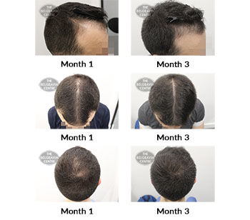 alert male pattern hair loss the belgravia centre 424675 23 09 2021
