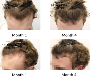 male pattern hair loss the belgravia centre 468153