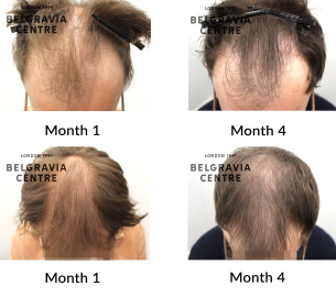 male pattern hair loss the belgravia centre 460506
