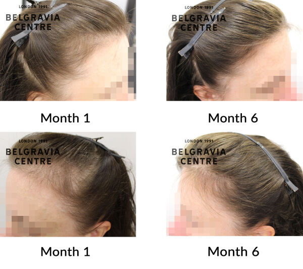 female pattern hair loss and diffuse hair loss the belgravia centre 449590