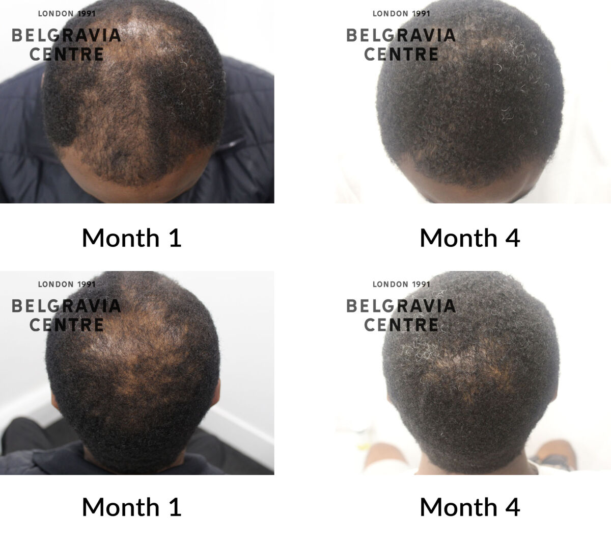 male pattern hair loss the belgravia centre 440530