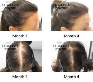female pattern hair loss and telogen effluvium chronic the belgravia centre 449108