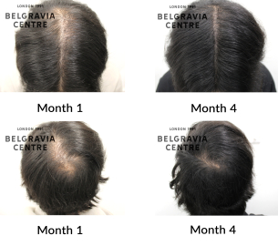 male pattern hair loss the belgravia centre 468955