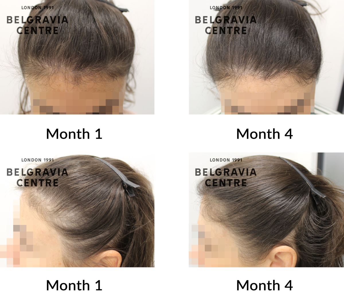 female pattern hair loss and diffuse thinning the belgravia centre 424430