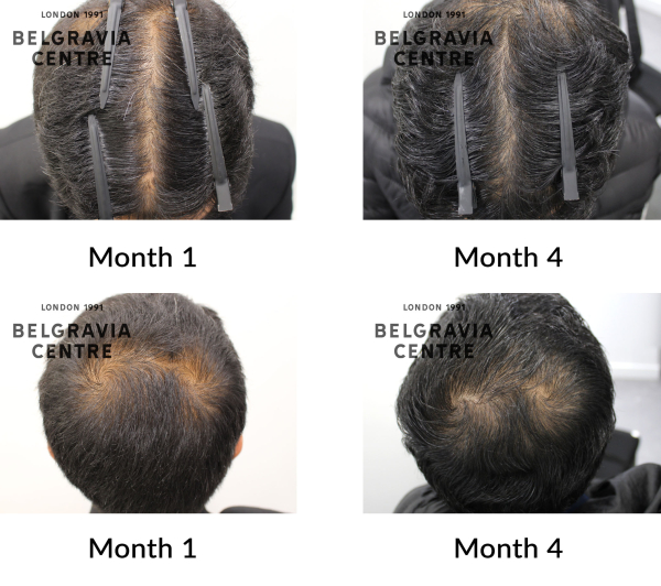 male pattern hair loss the belgravia centre 443732