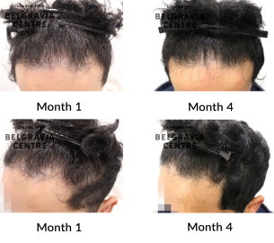 male pattern hair loss the belgravia centre 466840