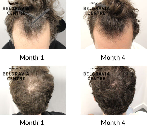 male pattern hair loss the belgravia centre 436971