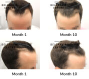 male pattern hair loss the belgravia centre 427333