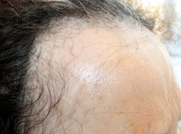 Example of Frontal Fibrosing Alopecia