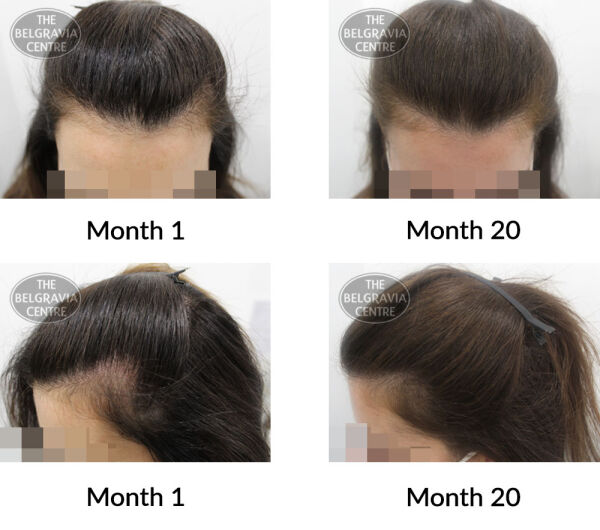 telogen effluvium and female pattern hair loss the belgravia centre 389901 21 06 2021