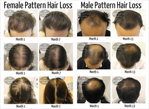View Over 1000 Patient Before After Images in our Hair Loss Success Stories1