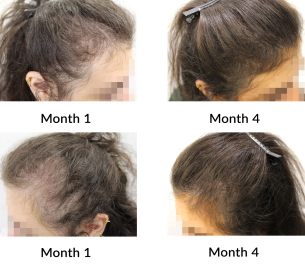 female pattern hair loss the belgravia centre 456859