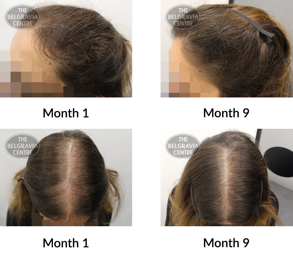 female pattern hair loss the belgravia centre 406141 26 05 2021