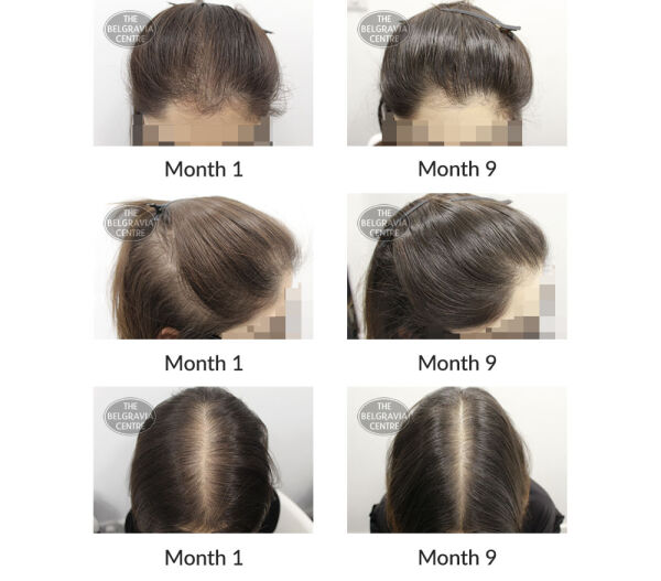 female pattern hair loss the belgravia centre 396439 02 11 2020