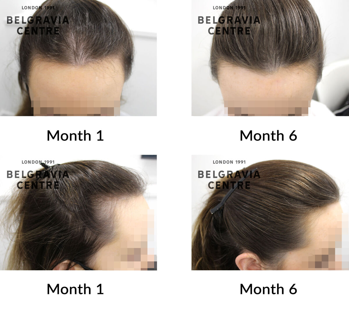 diffuse hair loss and telogen effluvium the belgravia centre 436005