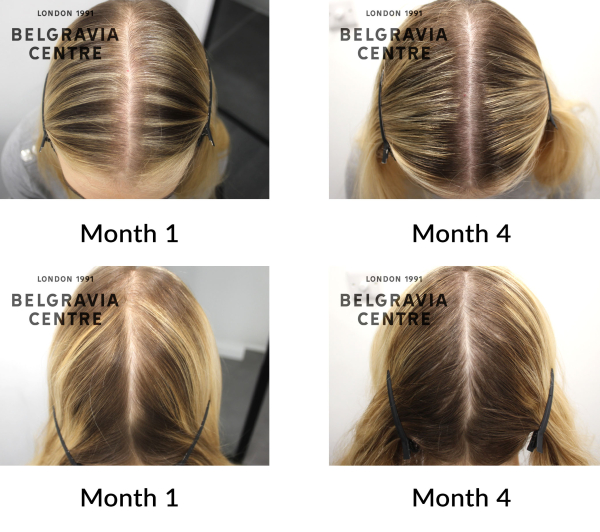 female pattern hair loss the belgravia centre 410508