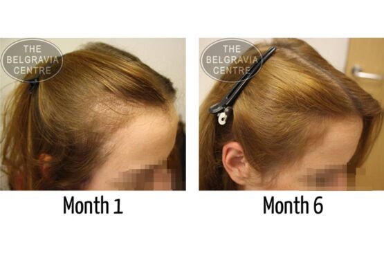Diffuse Hair Loss Treated Successfully at The Belgravia Centre Hair Loss Clinic
