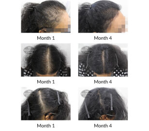 female pattern hair loss and telogen effluvium the belgravia centre 404267 16 10 2020