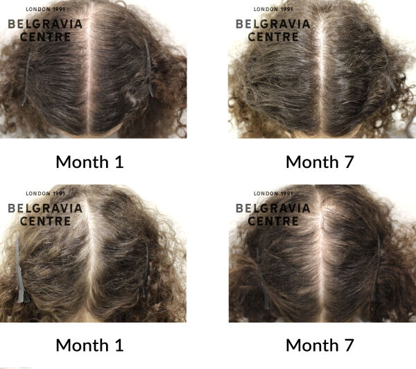 female pattern hair loss the belgravia centre 312304