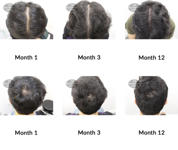 male pattern hair loss the belgravia centre 369490 30 10 2019