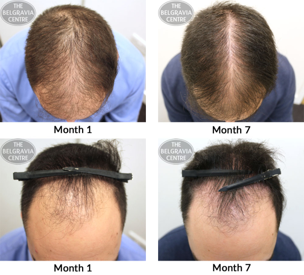 male pattern hair loss the belgravia centre dw 10 04 2017