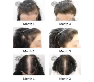 diffuse thinning and female pattern hair loss the belgravia centre 409222 24 12 2020