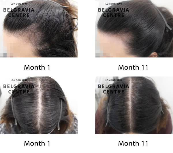 female pattern hair loss the belgravia centre 431871