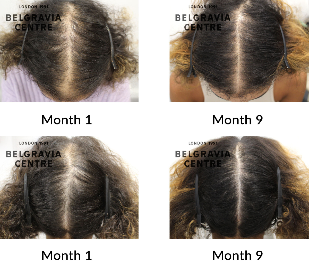 female pattern hair loss the belgravia centre 429943