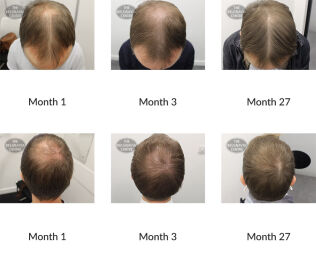 male pattern hair loss the belgravia centre 366899 03 11 2020