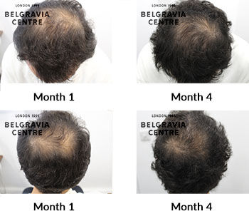 alert male pattern hair loss the belgravia centre 430984
