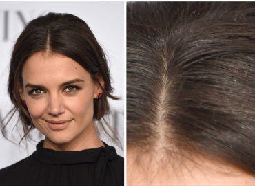 Could Katie Holmes Dandruff Be Caused By Cold Weather The Belgravia Centre Hair Loss Blog